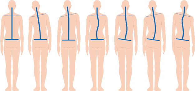 骨盤や姿勢の歪み